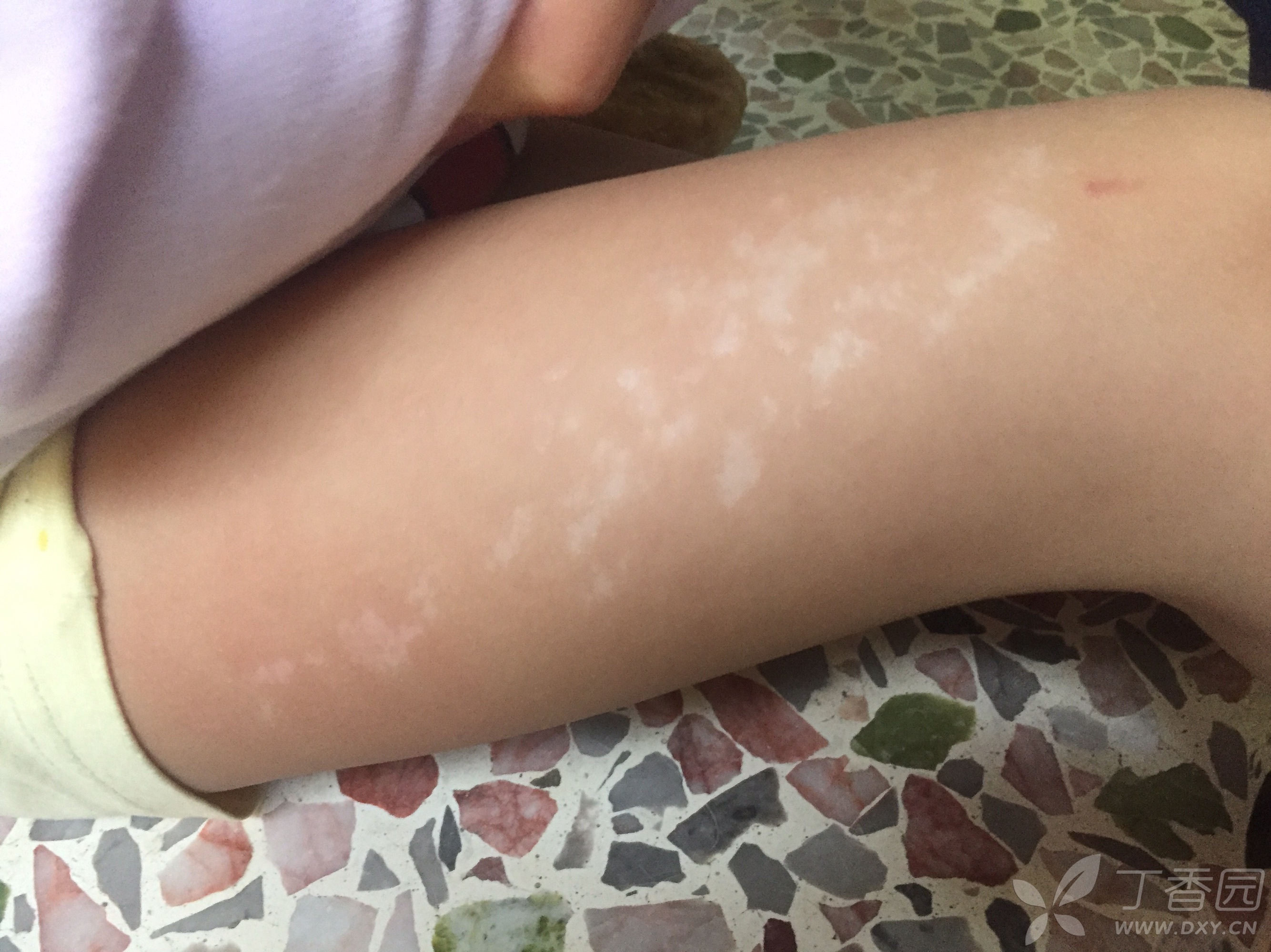 小孩大腿长 白斑 白癜风?