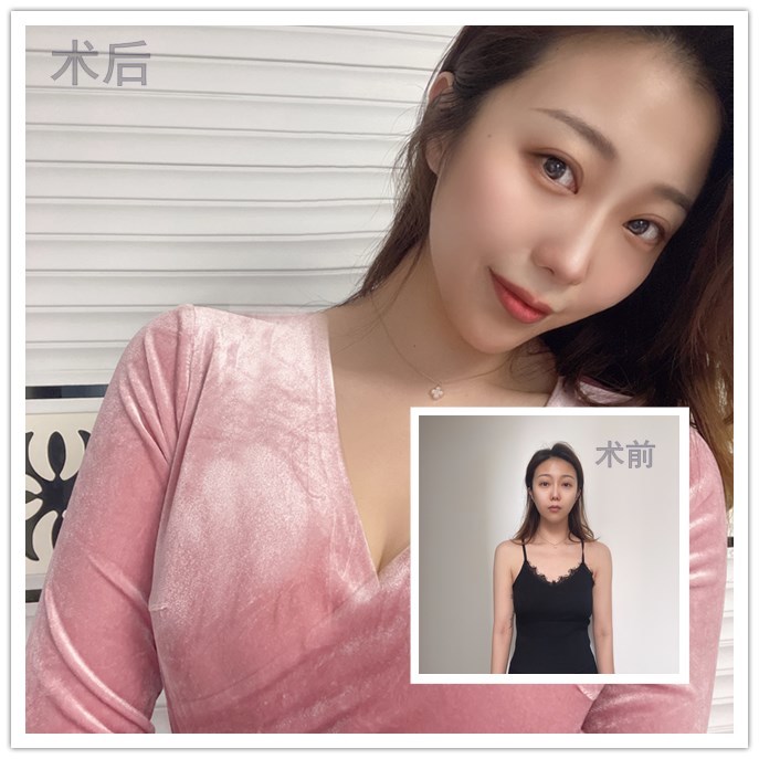 沈阳曼托假体隆胸1天——大家好,今天成功的做完了假_圈子-新氧美容