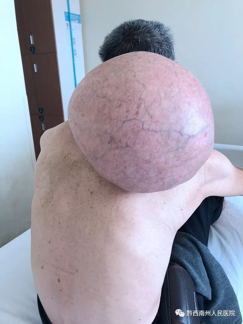 三十年沉疴一刀除——州人民医院成功切除罕见巨大脂肪肉瘤