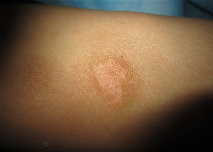 花斑癣头部脱毛症状图片