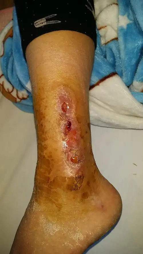 prp成功治疗胫骨骨不连腓骨骨髓炎(@张颖病例分享)