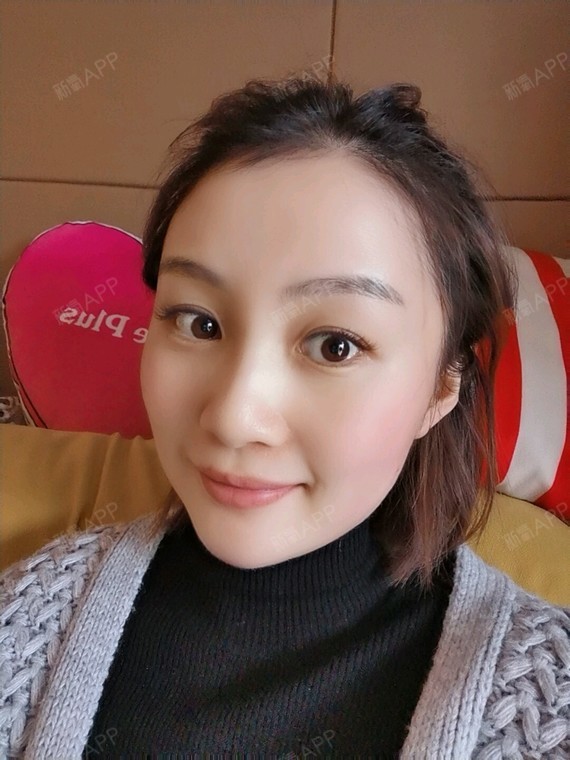 自体脂肪填充泪沟