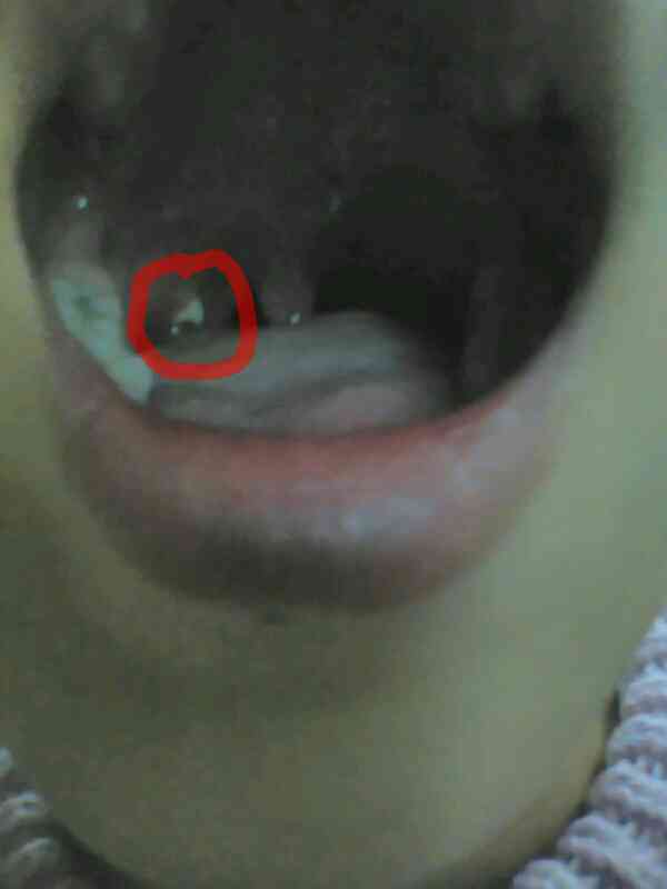 喉咙扁桃体旁边起了个乳白色米粒状的东西,不痛不痒,有异物感,有三四