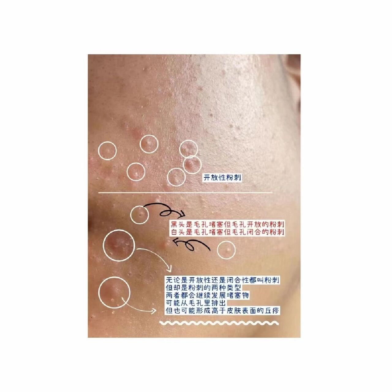 两种粉刺的区分,一图教你分辨出来93? 图片已缩小,介意慎点