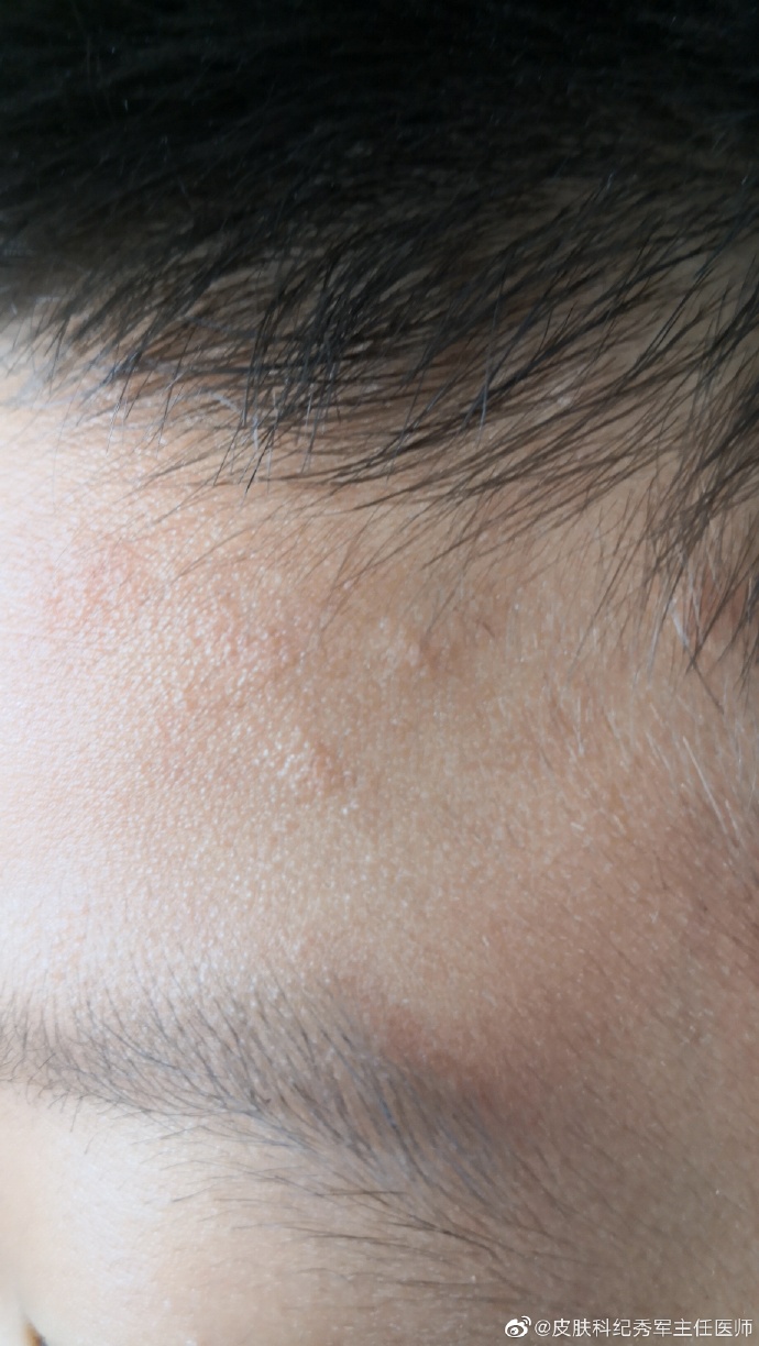 儿童额头和口周花斑糠疹/花斑癣/汗斑#医.