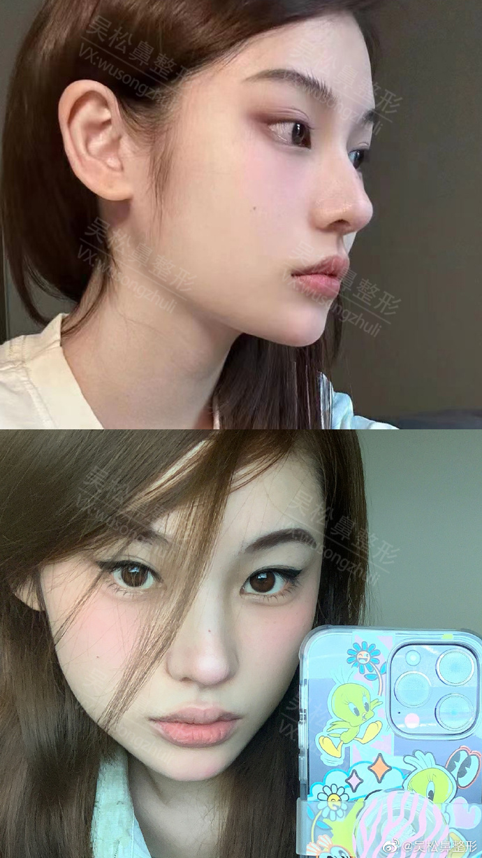 吴松鼻整形##美国射极峰##生活中好看的鼻子##名品鼻三要素##鼻整挝