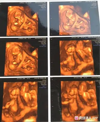 双胎nt秒过～双绒双羊