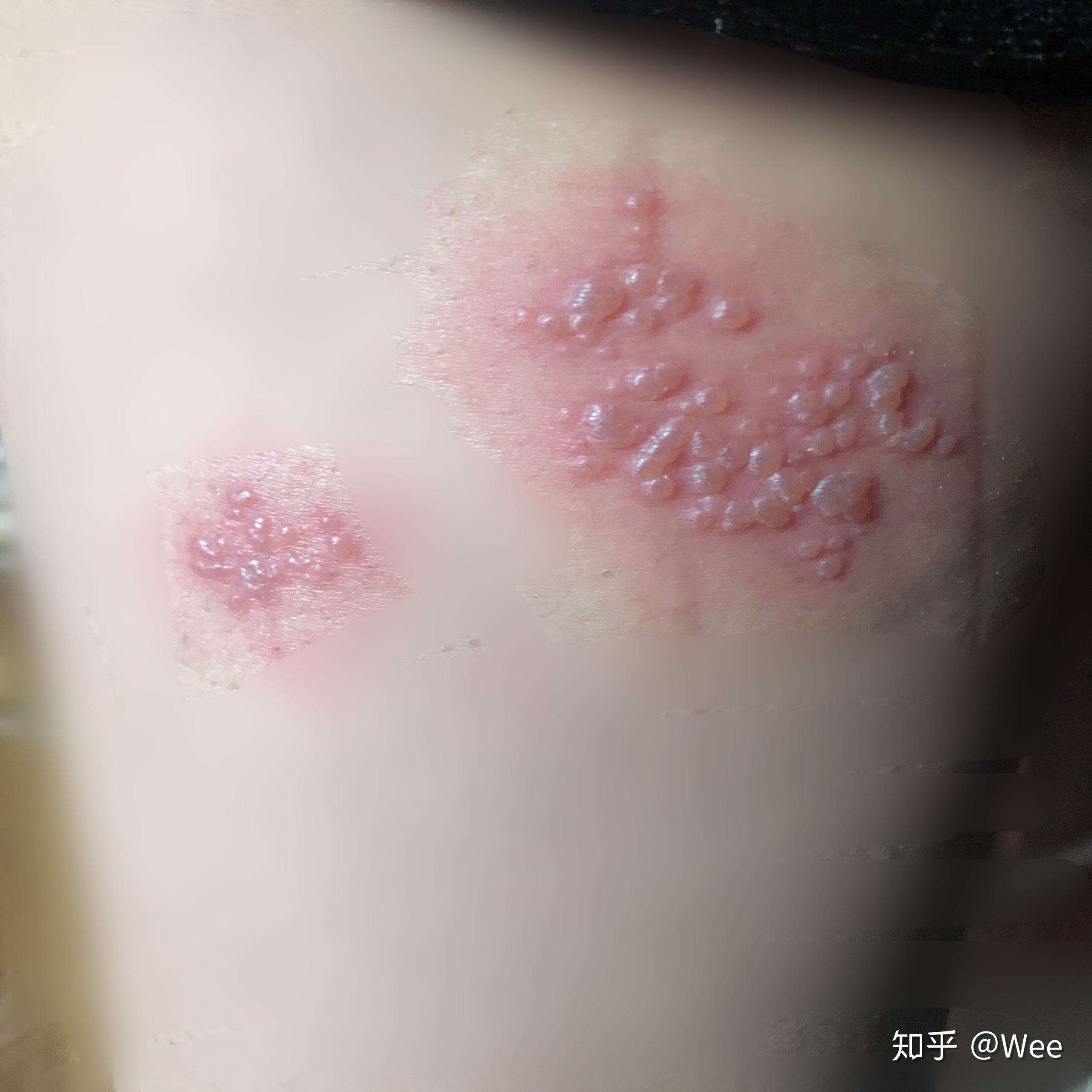 得了带状疱疹的症状及感受是什么