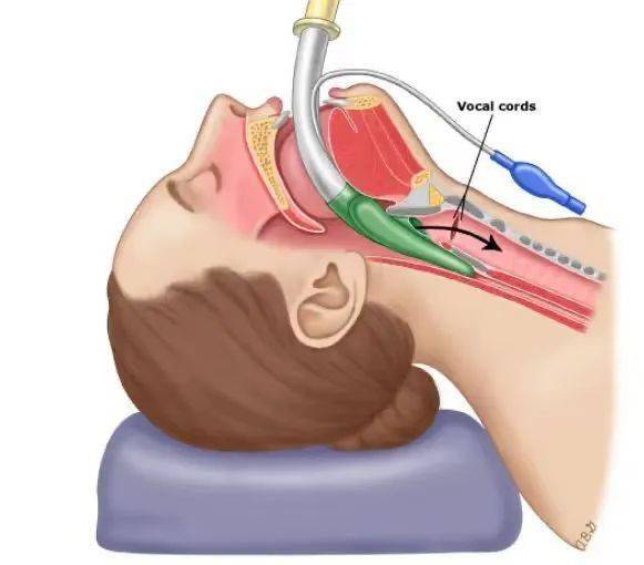 小儿麻醉 | 小儿喉罩保留自主呼吸流程_患者_患儿_诱导