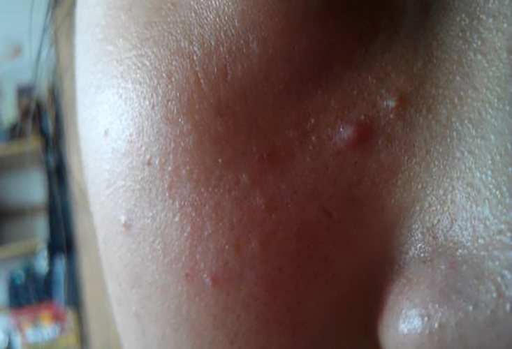 手臂脂肪粒图片