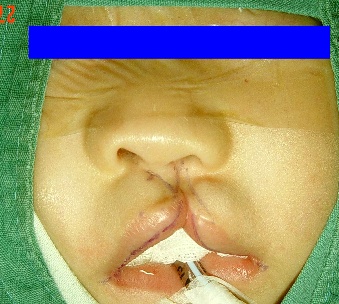 单侧唇裂手术 - 好大夫在线