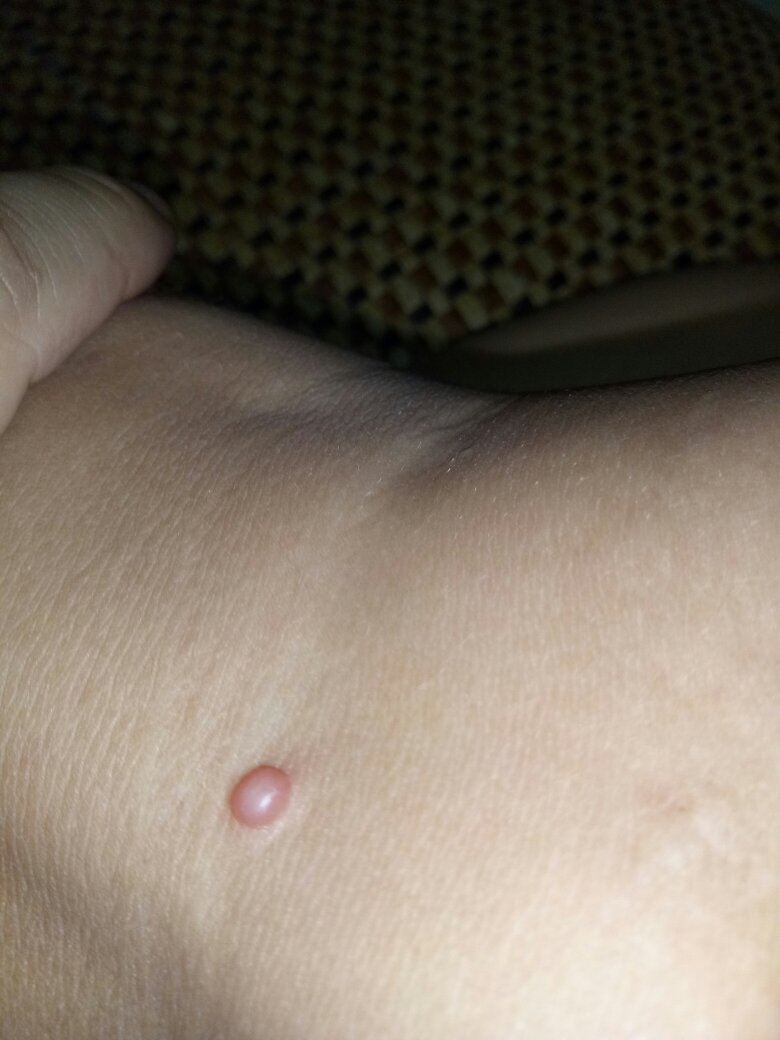 儿子8岁,小腿上面关节那位置长了这个肉粒,不是水泡,摸着不痛,比火柴