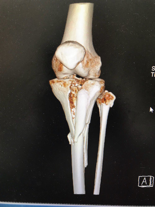 严重粉碎型胫骨平台骨折 - 好大夫在线