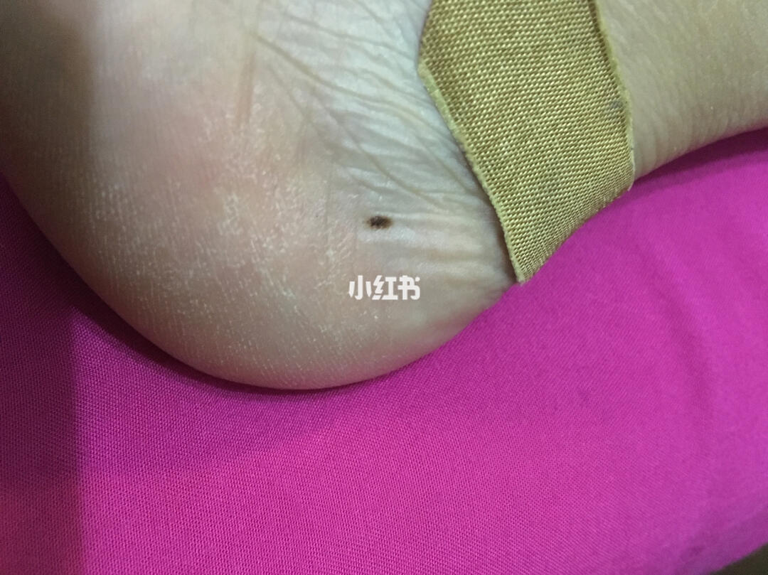 想问下这个脚后跟上的黑点(平的,不凸)需要去看医生不?