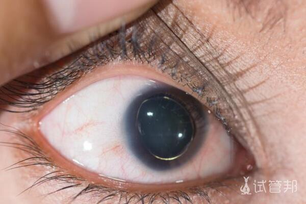 马凡综合征(马方综合征)发病症状有哪些