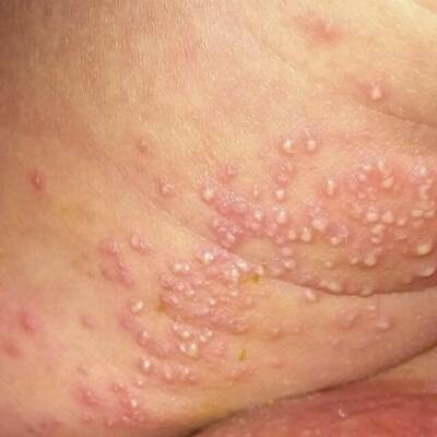 小孩这大腿内侧长的是湿疹吗_宝宝树