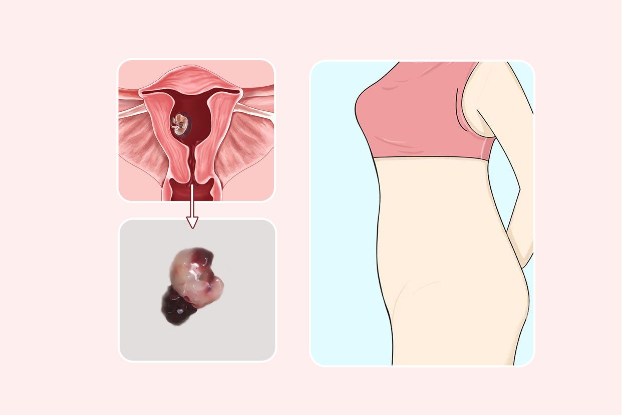 一个多月药流孕囊图片