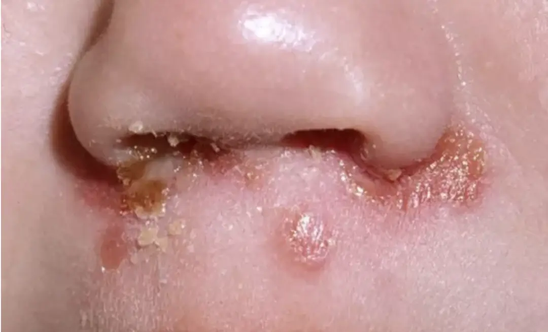 传染性超强的脓疱疮来了孩子们快跑