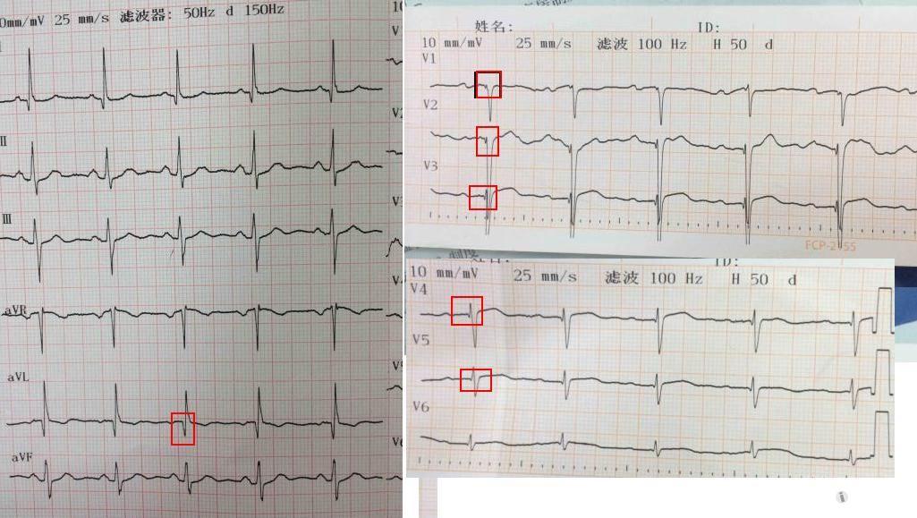 看看这样的异常q波,谢 - 心电图脑电图专业讨论版 - 爱爱医医学论坛