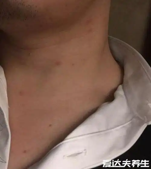 不同时期的艾滋病皮疹图片及症状,不痛不痒的小红点更需注意