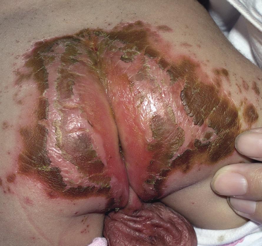 皮肤性病科图谱: 内分泌代谢性皮肤病 肠病性肢端皮炎