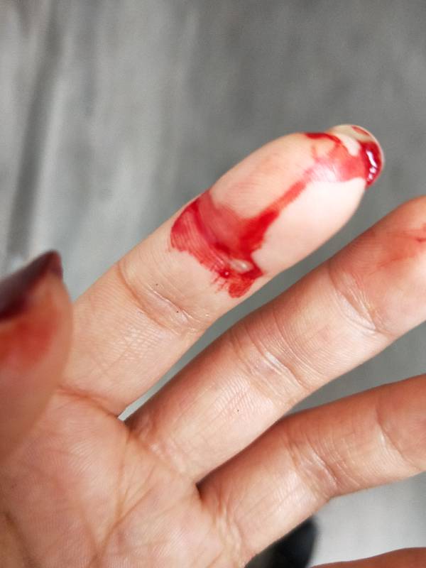 手指被亲戚家养的猫抓出血了,他们家的猫经常出门玩,平时也很温顺