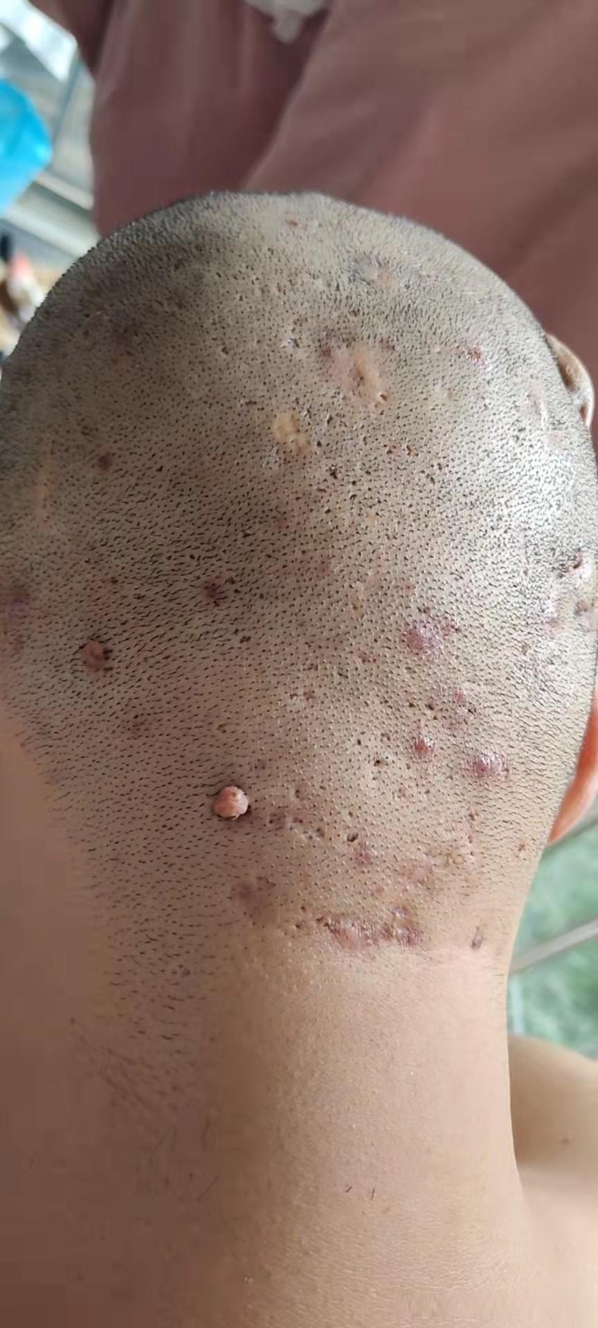 今天发来复诊照片的一位毛囊炎患者,男22岁,大学生.