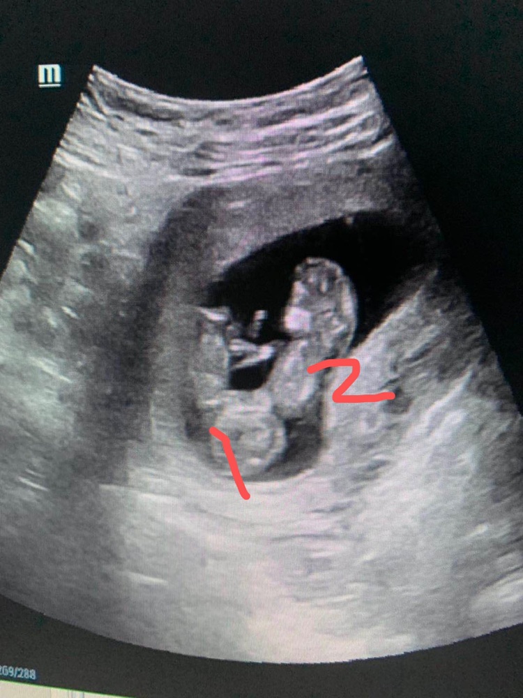 孕12周 5 单绒单羊双胞胎