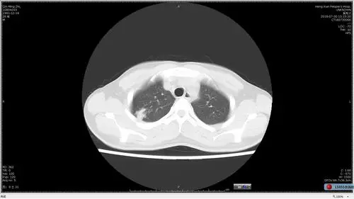 多发小结节状卫星灶的肺结核