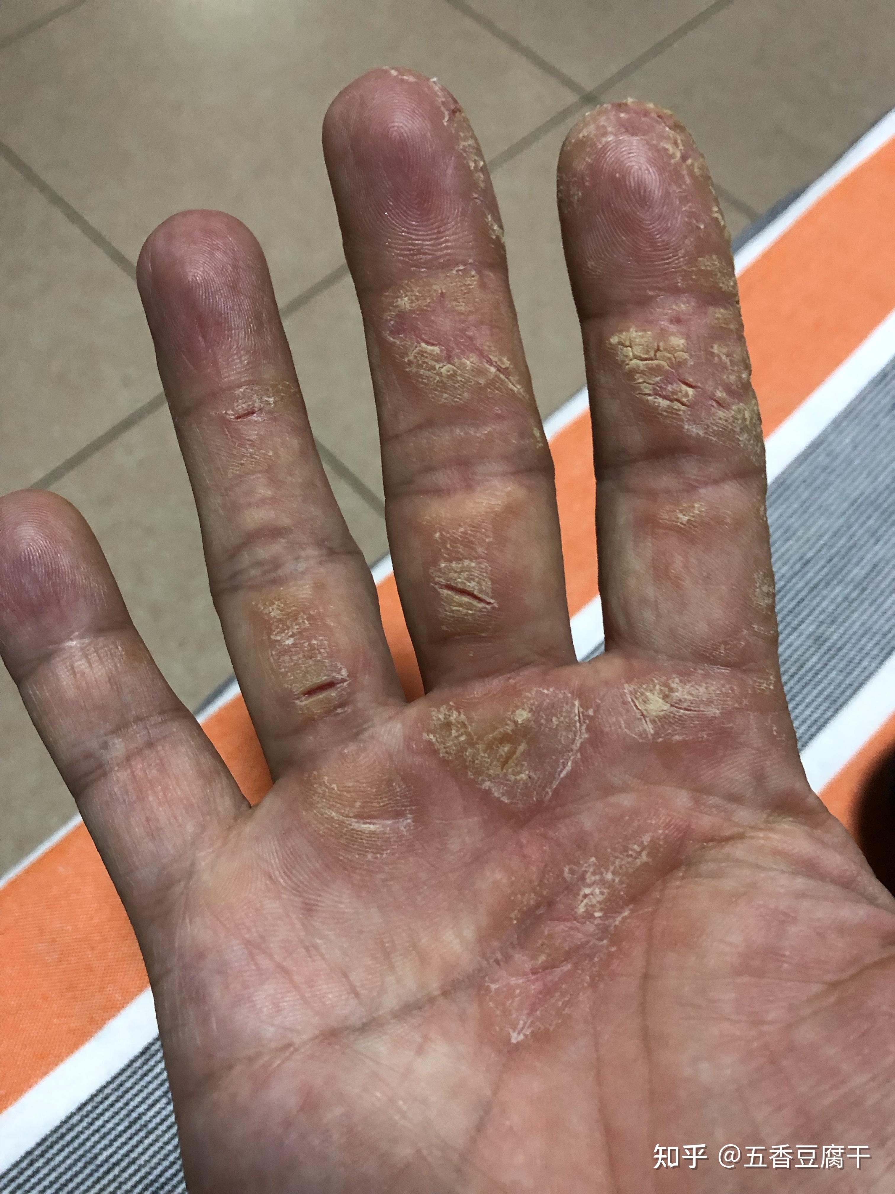 皲裂性湿疹的你是否慢慢失去了信心