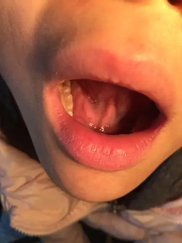 巨大,延及口底较深,必要时部分下颌骨离断,拟请口腔颌面外科专家手术