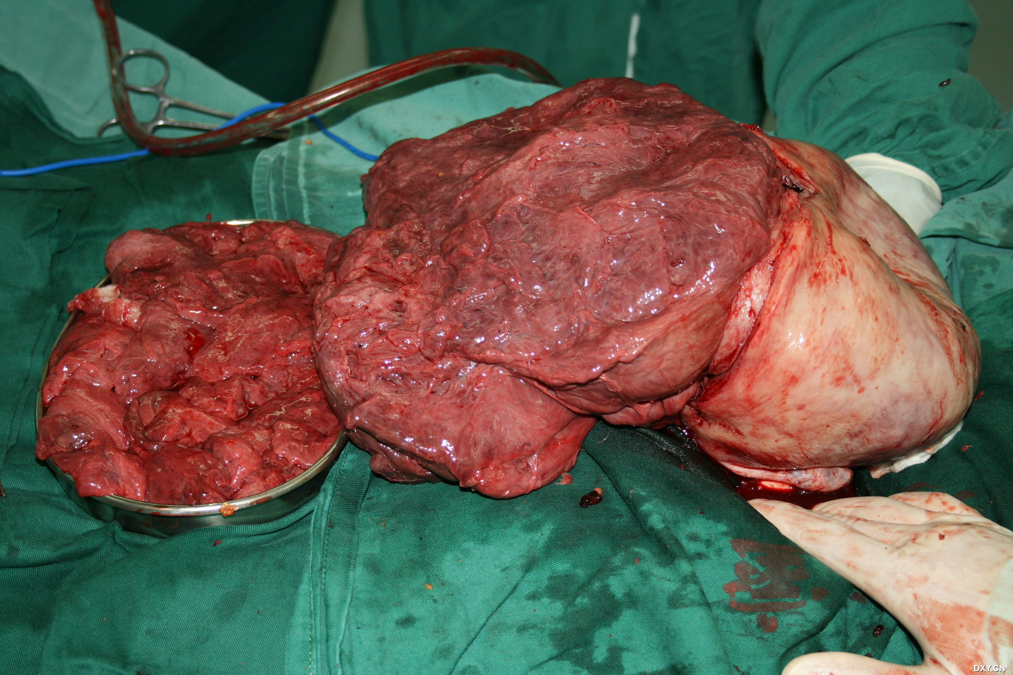 【图片】巨大子宫肌瘤伴红色变性