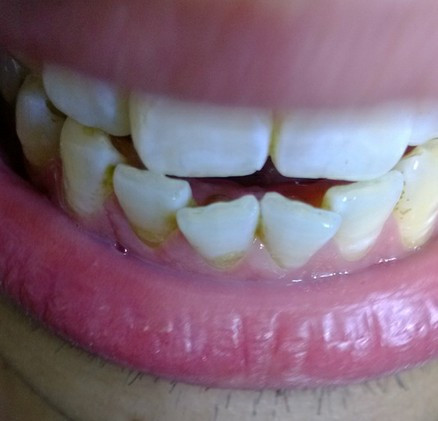 还会么 侧面看 两颗牙齿都很歪斜