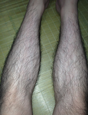 男人腿毛长而且黑,不敢穿短裤,也不敢去游泳,内附图 不喜勿进