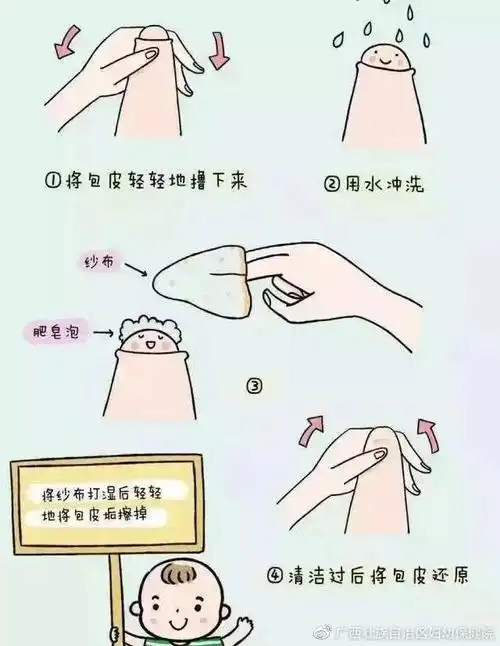 3岁以下男孩子多表现生理性包茎,如果没有合并局部反复炎症或排尿不畅