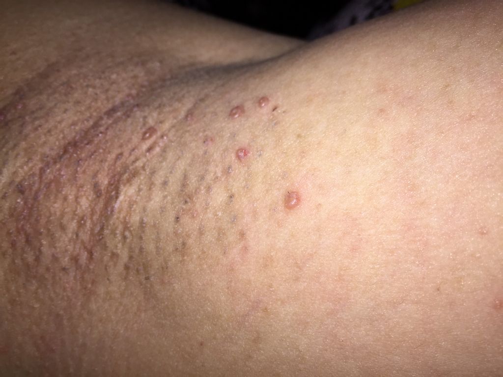 腋窝处长了小肉粒 长了八颗 怎么回事这是什么病?不痛