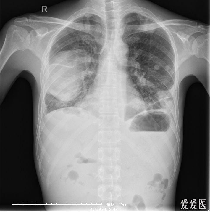 肺脓肿?咳嗽咳痰伴有发热,口干四天.