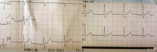 健康体检所见心电图1例