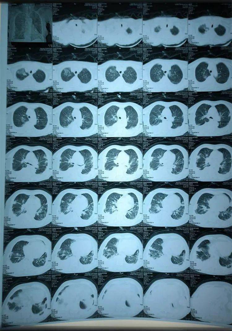 治疗前两肺炎症较重治疗前大量胸腔积液内三科主任李汉颖带领团队精心