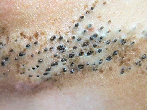 额头上长黑头粉刺怎么办