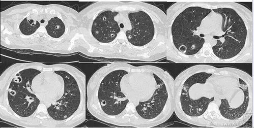 金葡菌肺炎——潘军平,肺部影像联盟