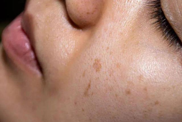 人为什么会长老年斑?涂牙膏,维生素e能去除老年斑吗?涨知识了