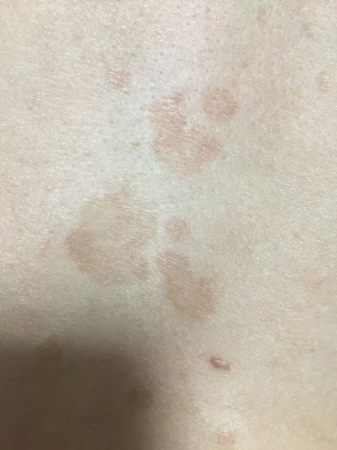 哪位医生能告诉我?老公身上的,是汗斑还是癣