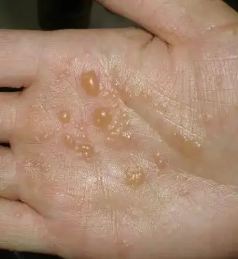 水泡型湿疹的症状和原因