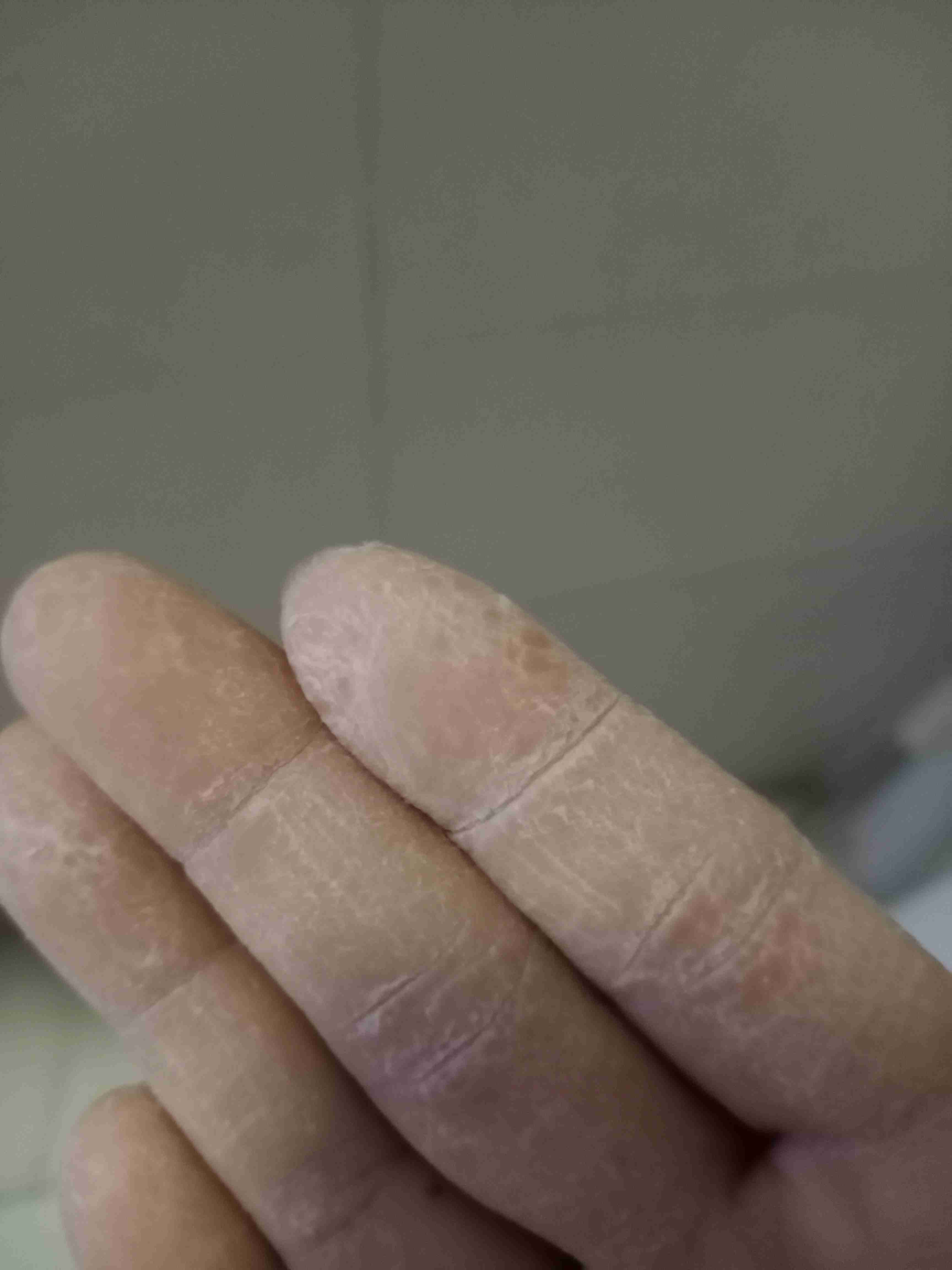 皲裂.一到冬天手和脚就开裂,怎么治,能治好吗?