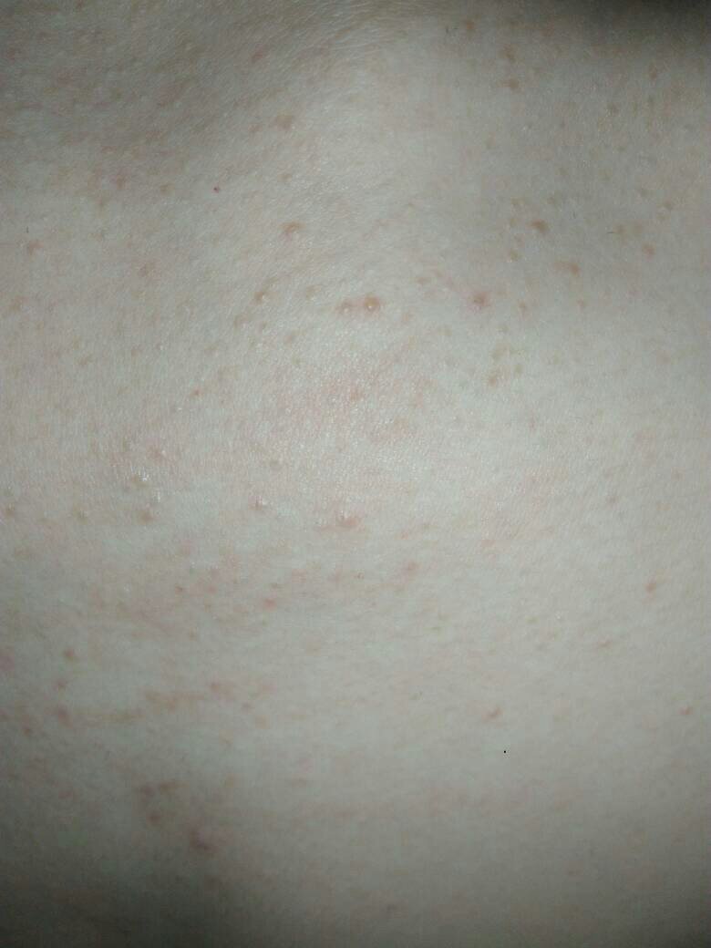 胸前长这样子的痘痘是怎么回事?是痱子吗?