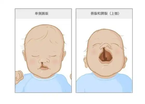 什么是唇腭裂 唇腭裂应如何治疗(图2)