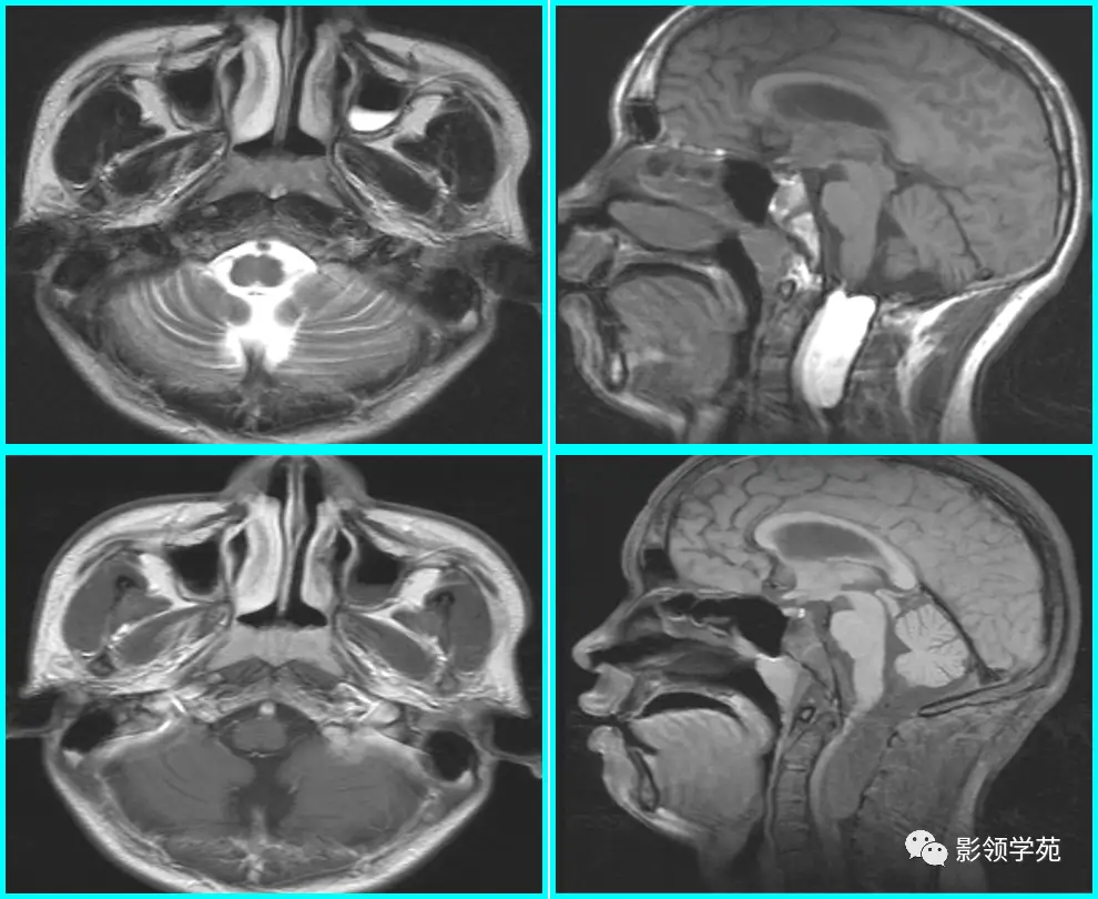 儿童腺样体肥大影像表现及诊断标准