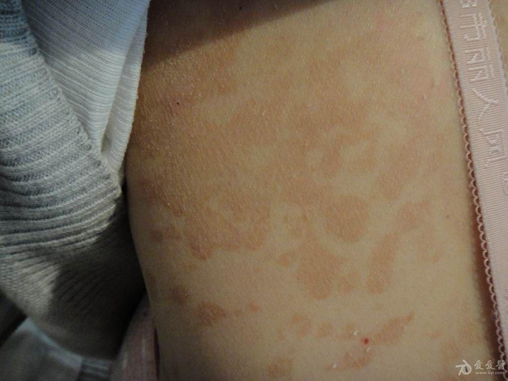 典型皮肤病之花斑癣(汗斑)