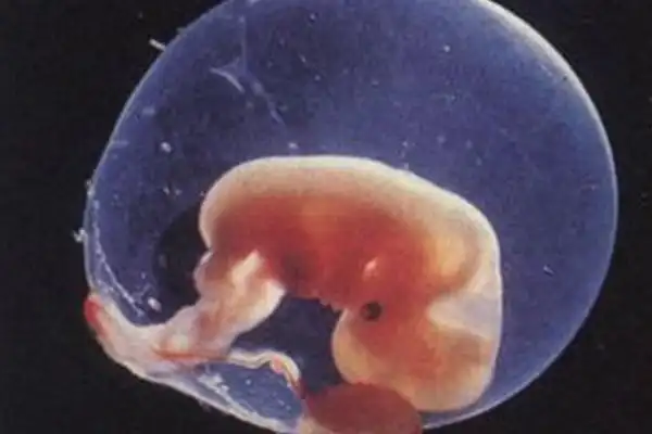 孕囊的形状比较规则